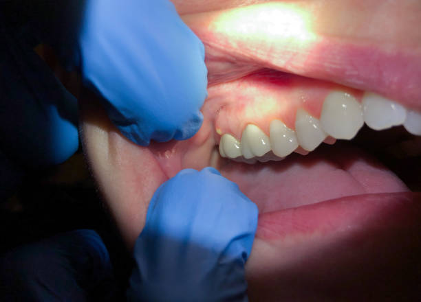 Best Dentist for Tooth Abscess  in Wright, FL